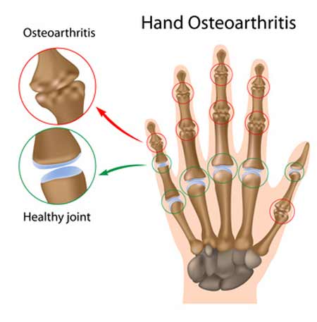 Fingerarthrose